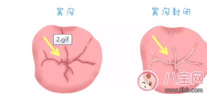 寶寶蛀牙不給醫(yī)生看 如何預(yù)防蛀牙減少寶寶痛苦