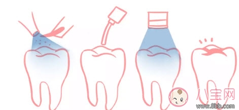 寶寶蛀牙不給醫(yī)生看 如何預(yù)防蛀牙減少寶寶痛苦