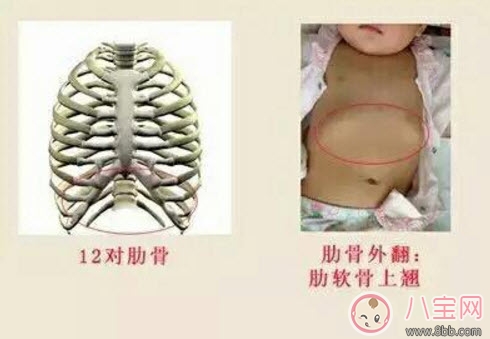 寶寶肋骨外翻的癥狀有哪些 寶寶肋骨外翻怎么辦