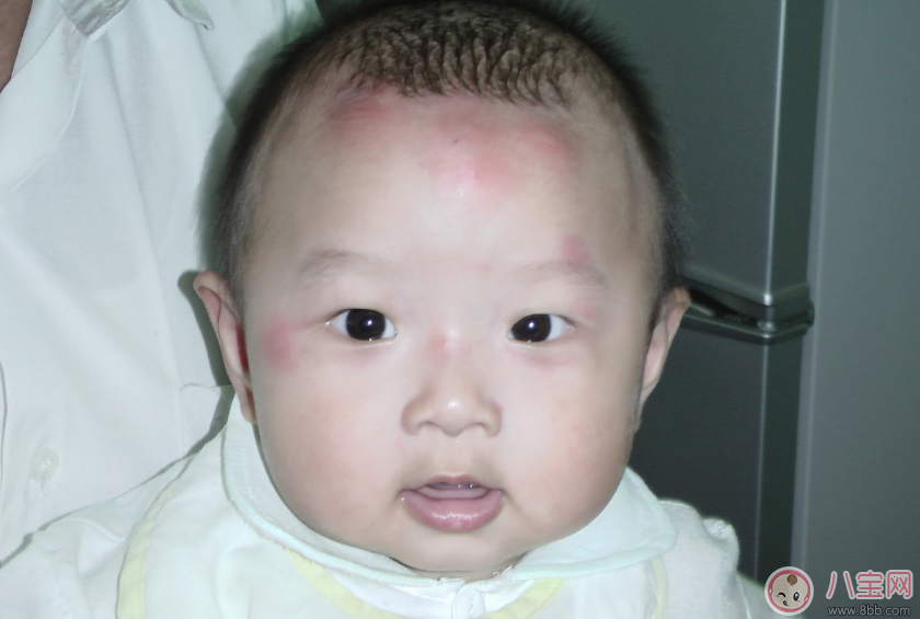 孩子用花露水竟然出現(xiàn)狀況 驅(qū)蚊給孩子用什么好