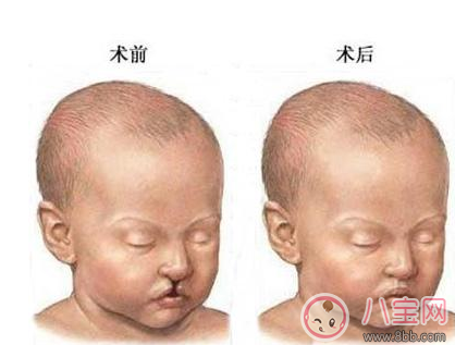 寶寶是兔唇怎么辦    兔唇治得好嗎