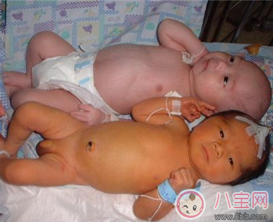 小兒黃疸嚴重嗎 黃疸怎么治 小兒黃疸嚴重嗎 黃疸怎么治