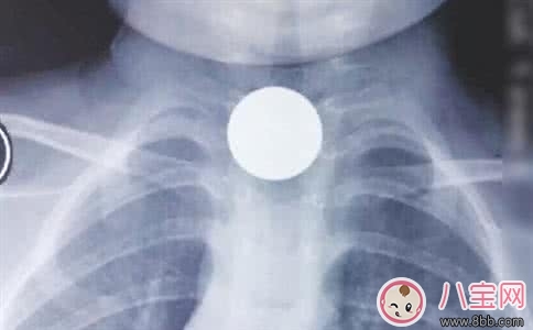 孩子誤吞硬幣的急救方法寶媽必知 孩子誤吞硬幣的急救方法寶媽必知